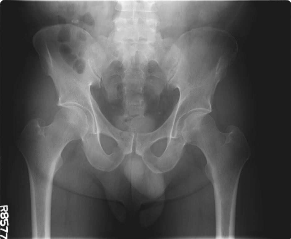Pelvic X Ray Anatomy Radiology How To Do Pelvis X Ray Full Sexiezpix Web Porn