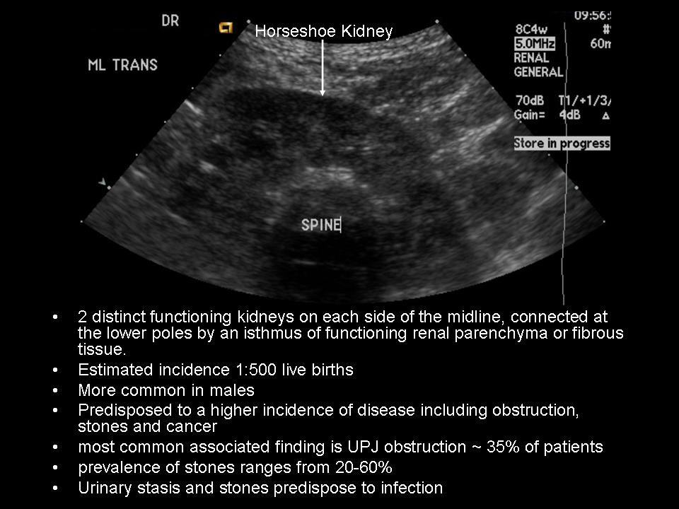 Horseshoe Kidney Complications. Horseshoe+kidney+on+