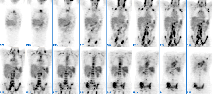 lymphoma-pet-scan-lymphoma