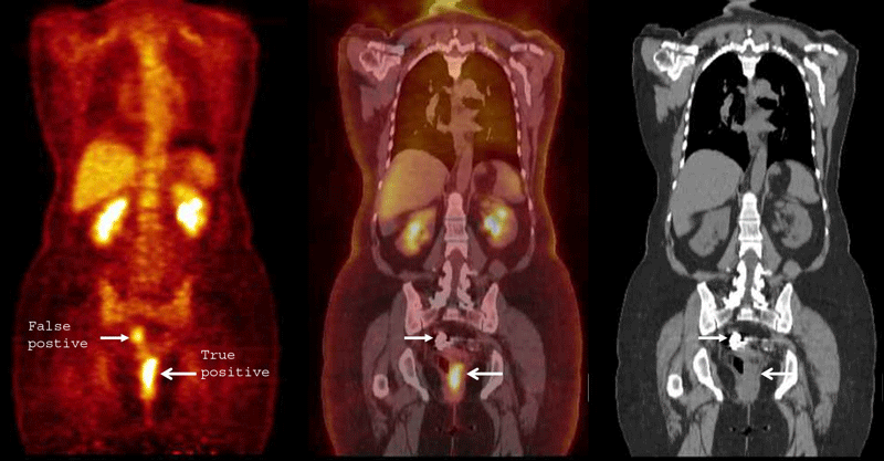 pet scan colon cancer