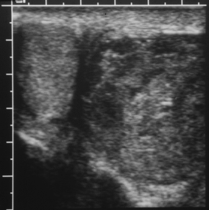 ultrasound testicle testicular left third